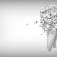 Jak wygląda zabieg wszczepienia implantu zębowego?